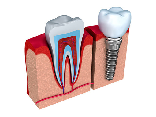 Dental Implants offered at out Walled Lake Dentist Office