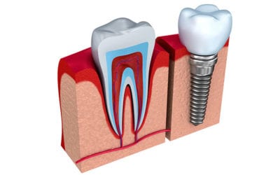 Walled Lake Dentist Helping Patients Care for Dental Implants