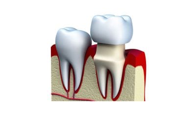 Improve Your Smile With Dental Crowns