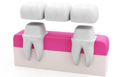 Dental Bridges and Oral Health | Walled Lake Dentist