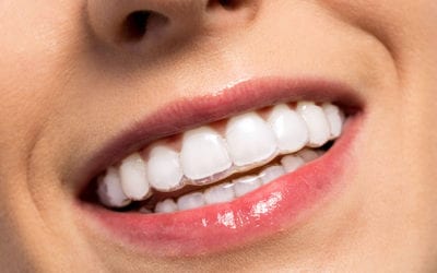 Show Off Your Beautiful Smile with Invisible Braces | Walled Lake Dentist