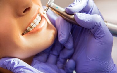 The Dangers of  DIY Braces | Walled Lake Dentist