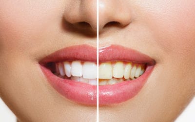 Professional Teeth Whitening: Is It Right for You? | Walled Lake